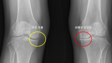 A knee X-ray image showing the difference between healthy and arthritic knees