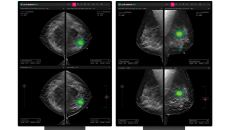 Mammography images side-by-side with and without AI to detect breast cancer