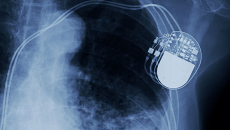 X-ray with implanted device