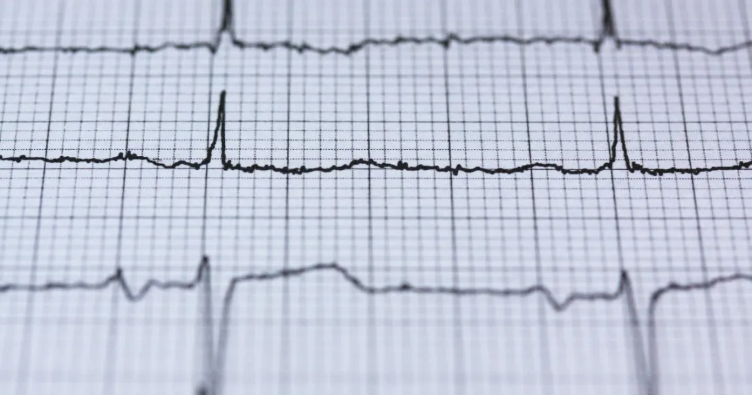 An EKG readout