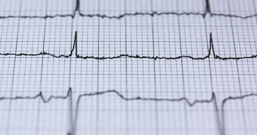 EKG read out