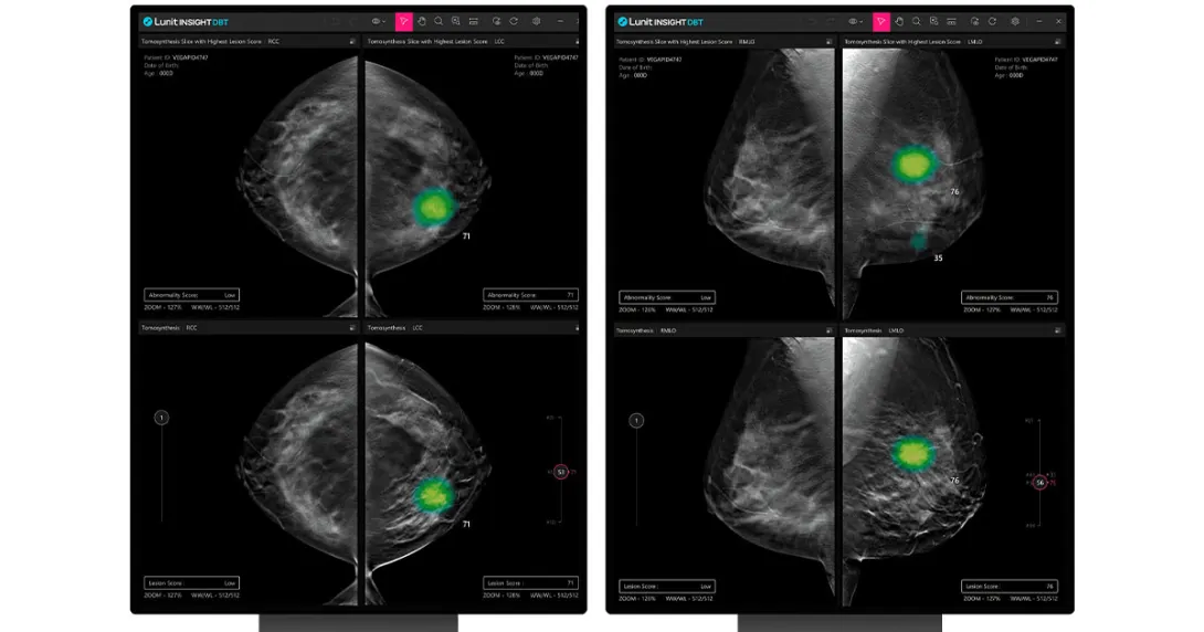 Mammography images side-by-side with and without AI to detect breast cancer