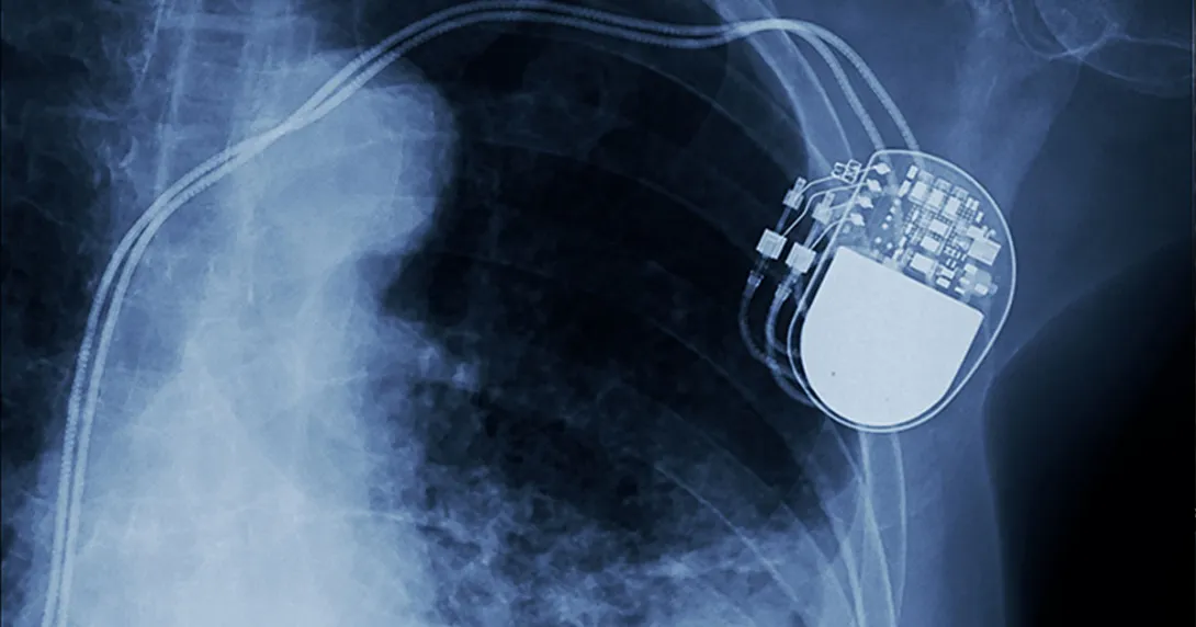 X-ray with implanted device